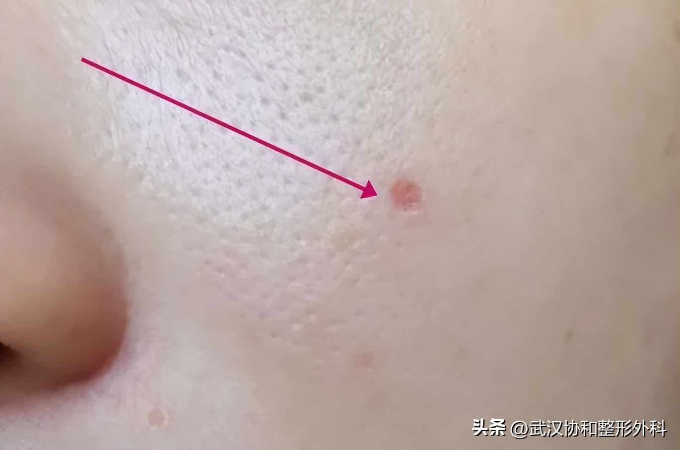 激光点痣红印多久才消除,激光点痣恢复全过程图片