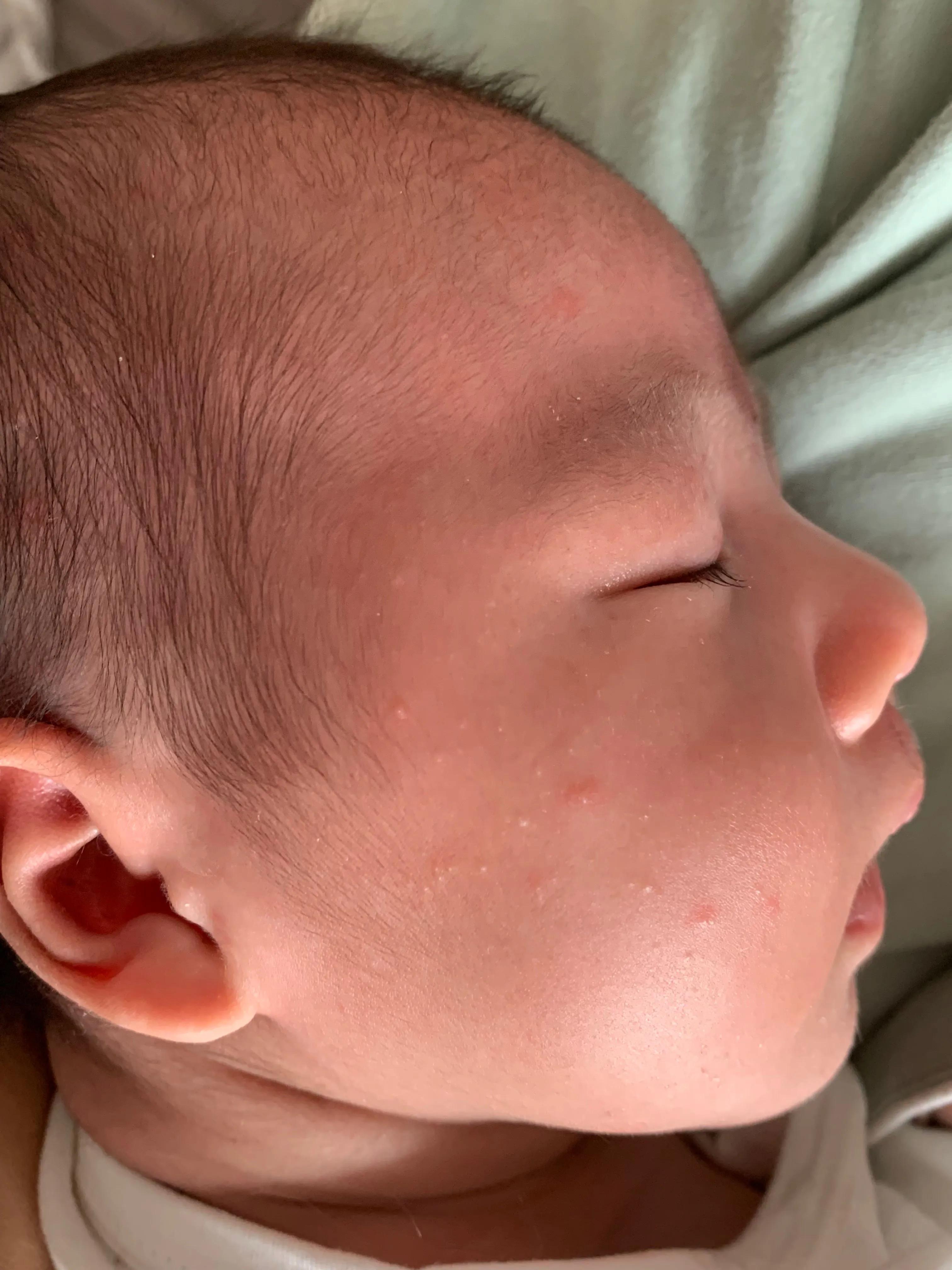 满月婴儿湿疹挂什么科,满月婴儿长湿疹抹什么药膏