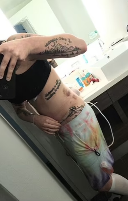 女士缩胸整形手术,美国辣妈做缩胸手术