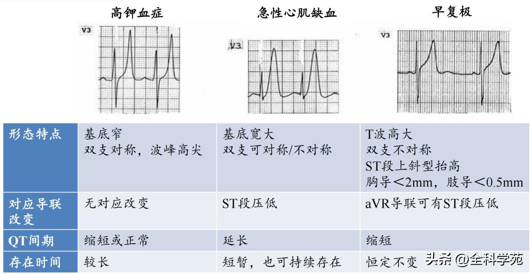 t波高尖心电图判断标准,t波高尖判断标准