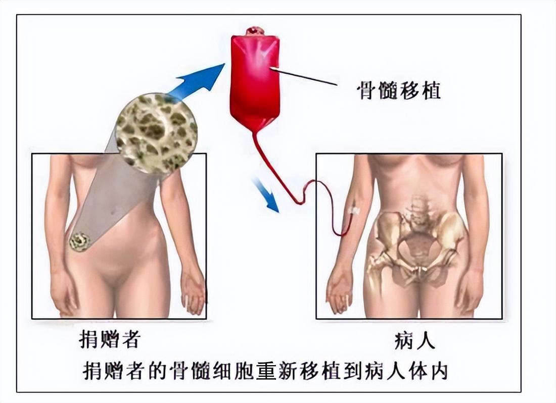 再生障碍性贫血造血干细胞移植,再生障碍性贫血骨髓移植是什么