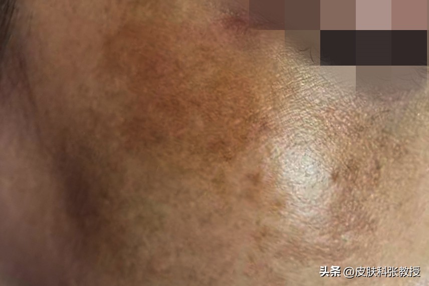 10岁女孩脸上长斑点怎么治,13岁男生脸上长褐色斑怎么治