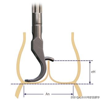最先进的主动脉瓣二瓣叶畸形修复术（2020版）