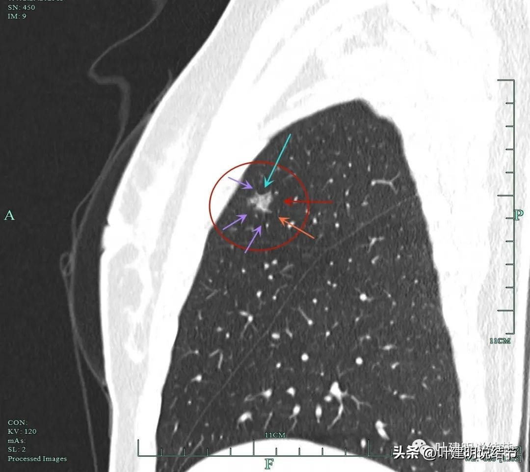 磨玻璃结节伴有增生是癌症吗,磨玻璃结节会是别的癌转移的吗