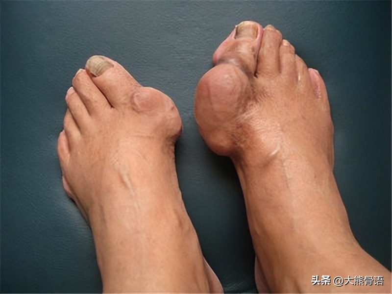 手指痛风的初期症状和治疗,脚踝痛风的症状和治疗方法
