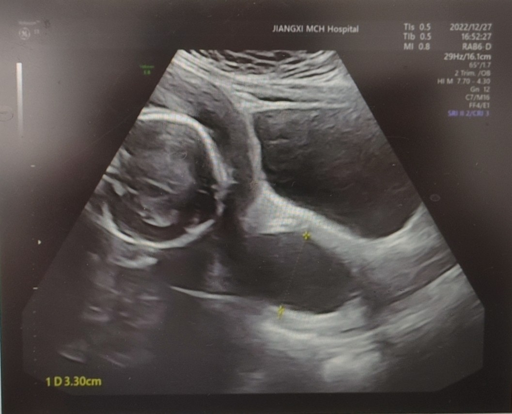 延迟分娩最长要多久,延迟分娩16天