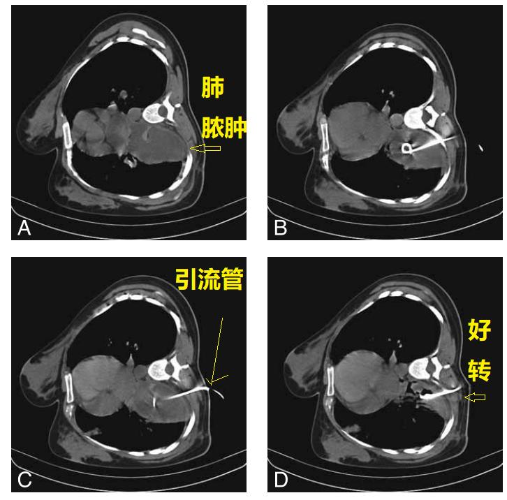 肺脓肿导管引流,肺脓肿的引流管脱落怎么办