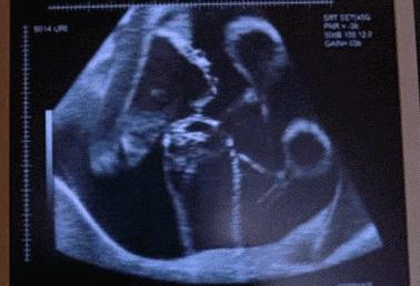 宫外孕，爱的故事上集