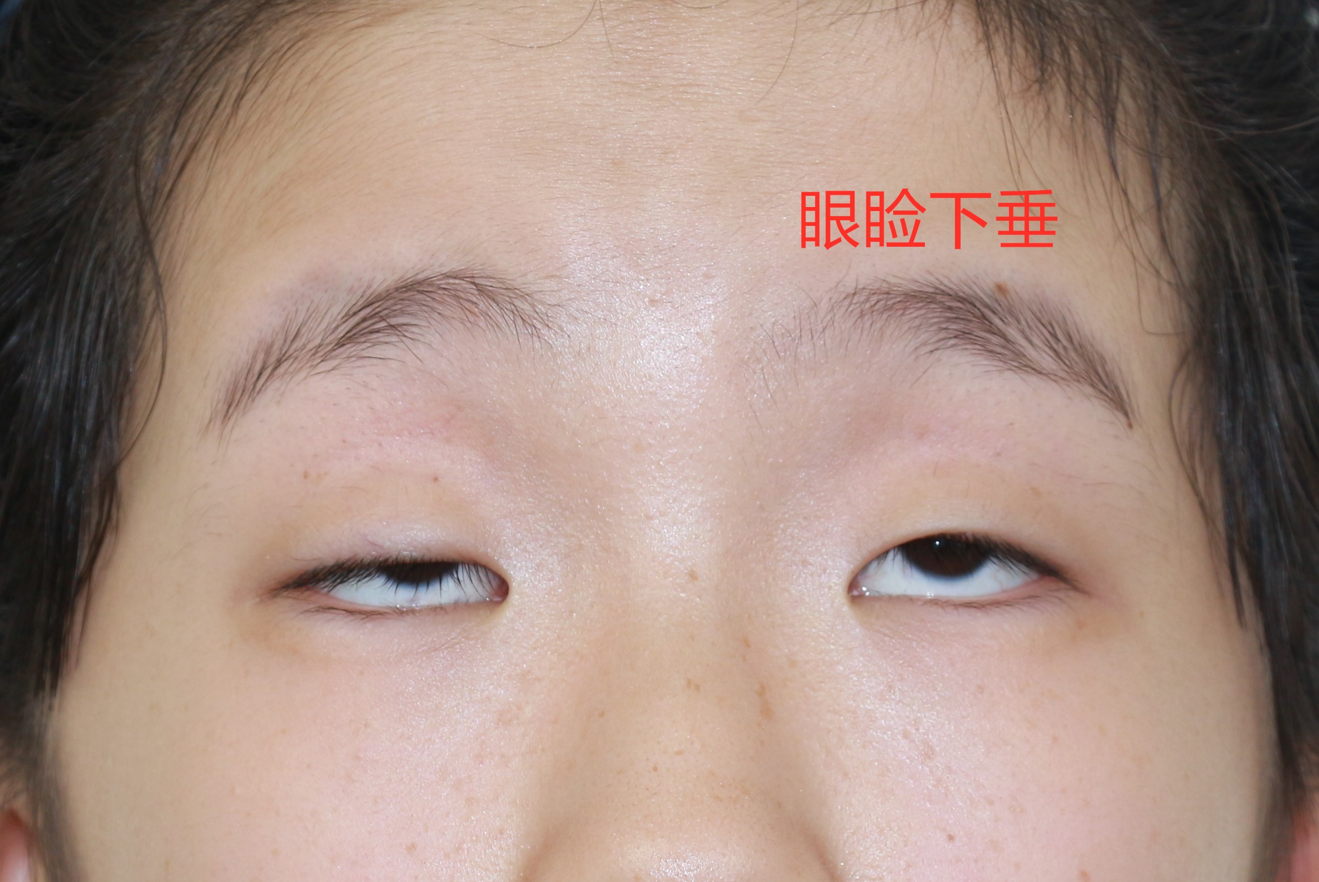 儿童上睑下垂怎么矫正,有什么方法可以帮助孩子上睑下垂