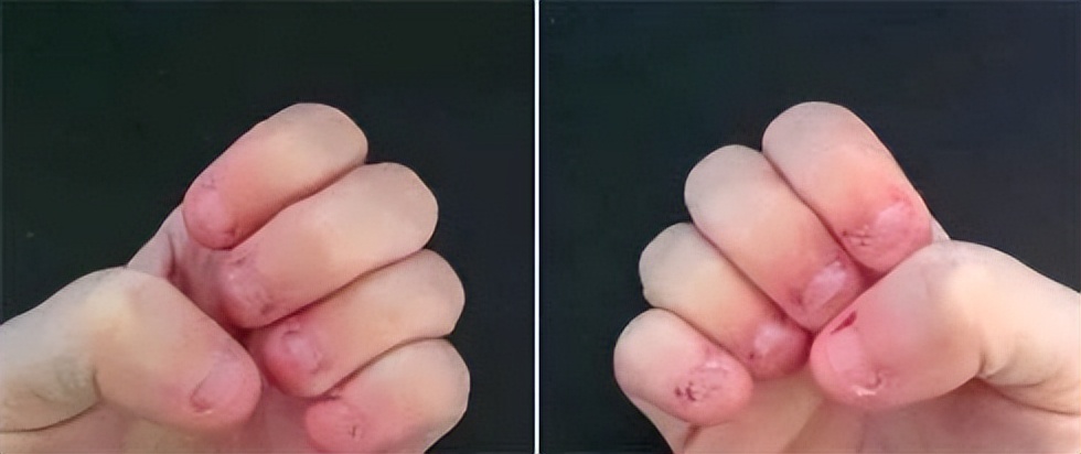 从小“咬指甲”的孩子，长大后怎么样了？一般逃不掉3种结局