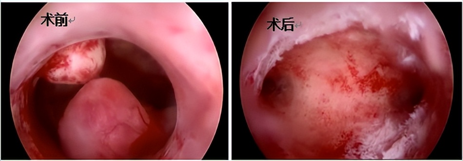 无X生活也能不损伤CN膜切除子宫内膜息肉？
