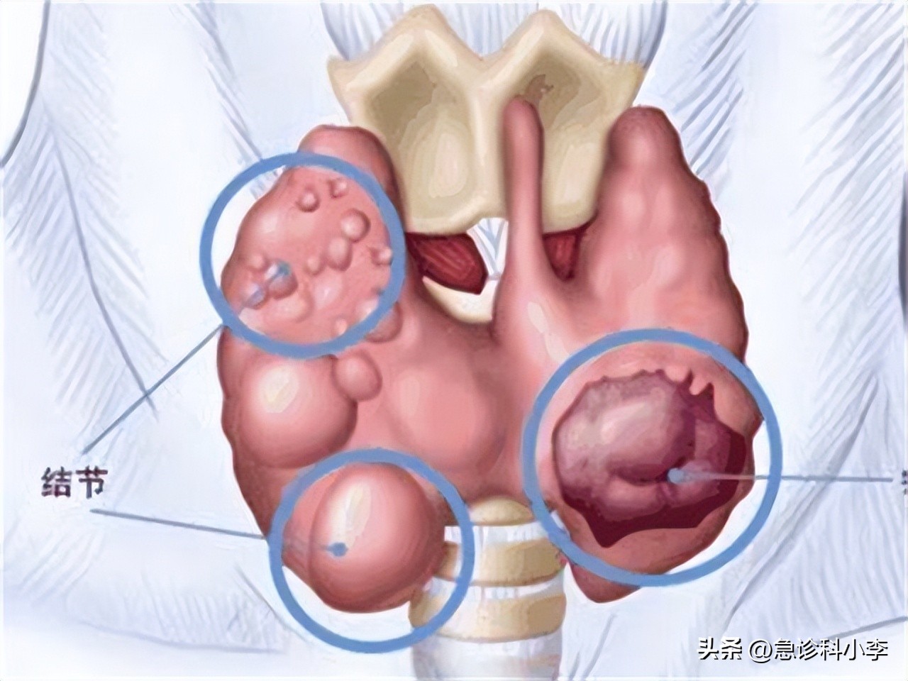 甲状腺实性结节4a癌变几率有多大,长了甲状腺结节癌变的几率有多大