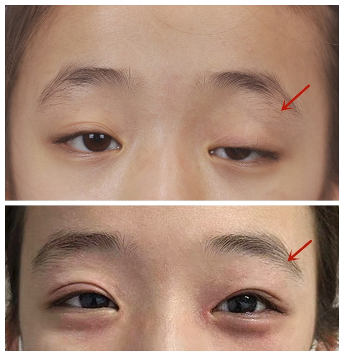 儿童上睑下垂怎么矫正,有什么方法可以帮助孩子上睑下垂