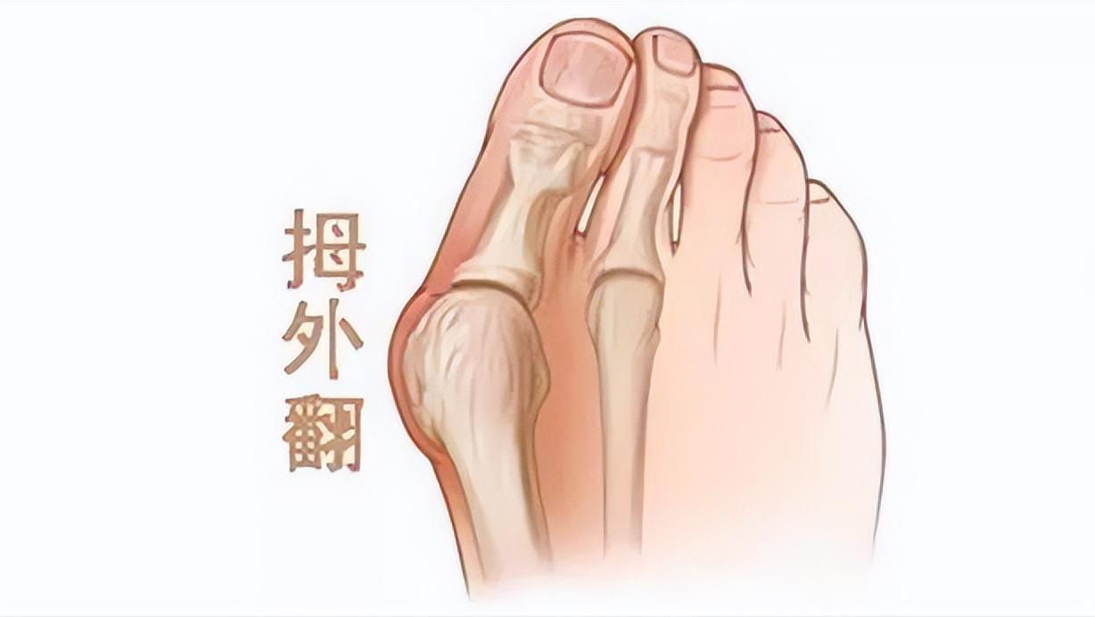 小孩脚底板磨出茧子走路特别疼,脚底板爱进风什么原因