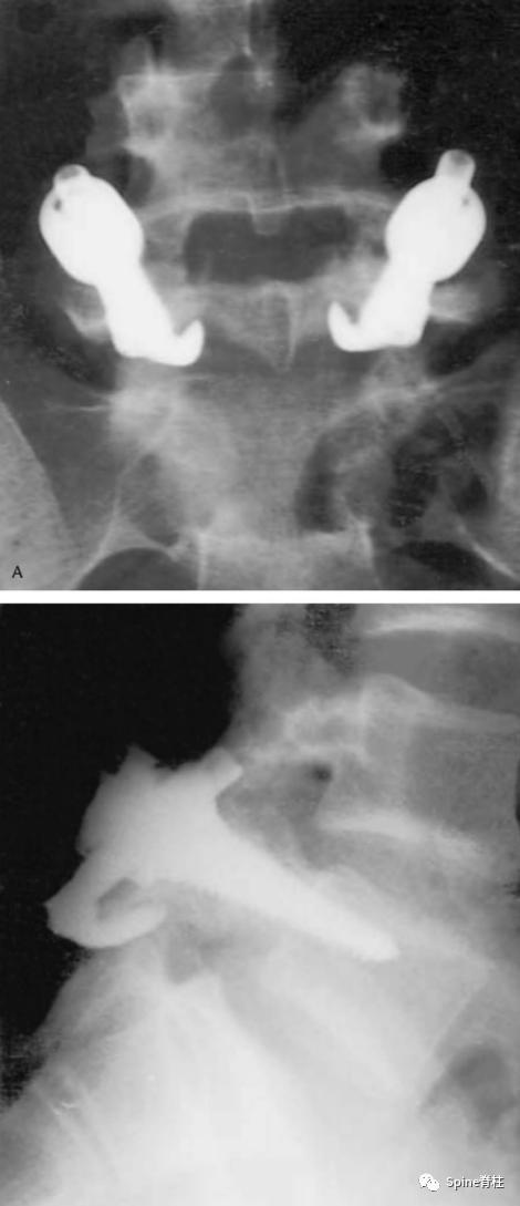 峡部裂和隐性峡部裂有区别吗,单纯峡部裂可以做峡部修复吗