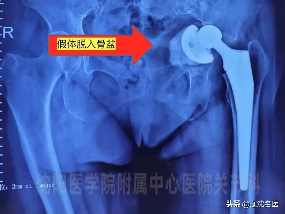 人工髋关节翻修3d打印,大连医院骨科3d打印