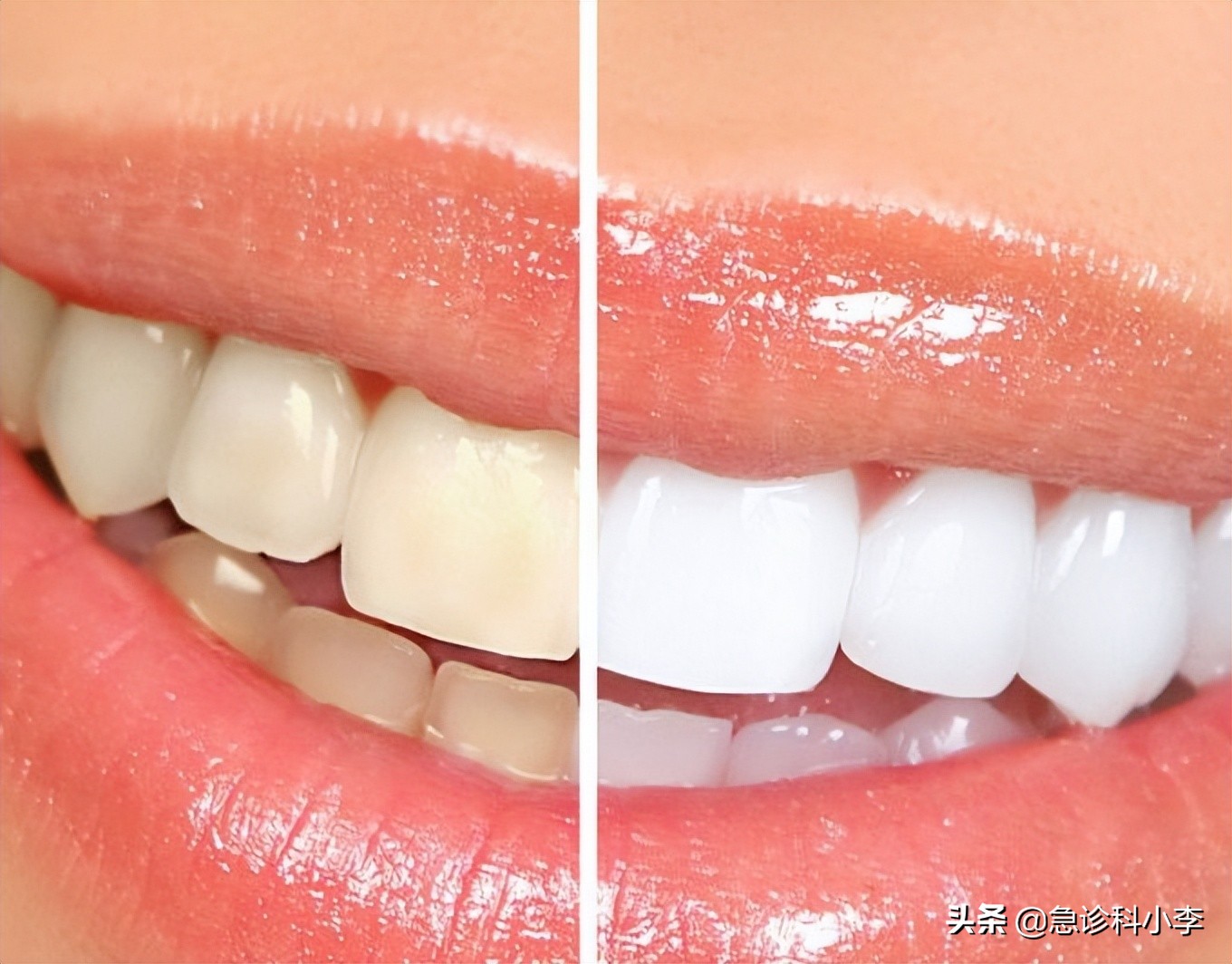 牙缝间的牙结石怎么清除,牙缝里的牙结石怎么去除