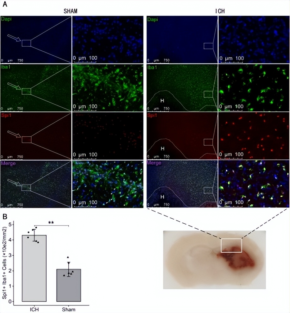 浙江大学虞军团队揭示Spi1是脑出血的潜在关键干预靶点