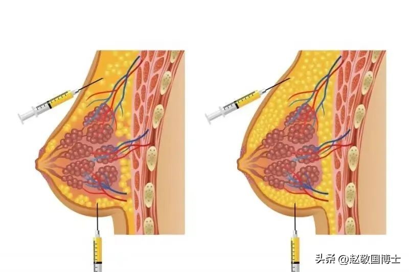 怎样预防面部下垂,如何预防胸下垂松弛