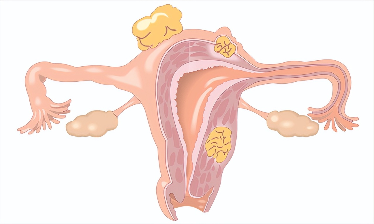 子宫肌瘤什么情况下要切除,子宫肌瘤可以反复切除吗