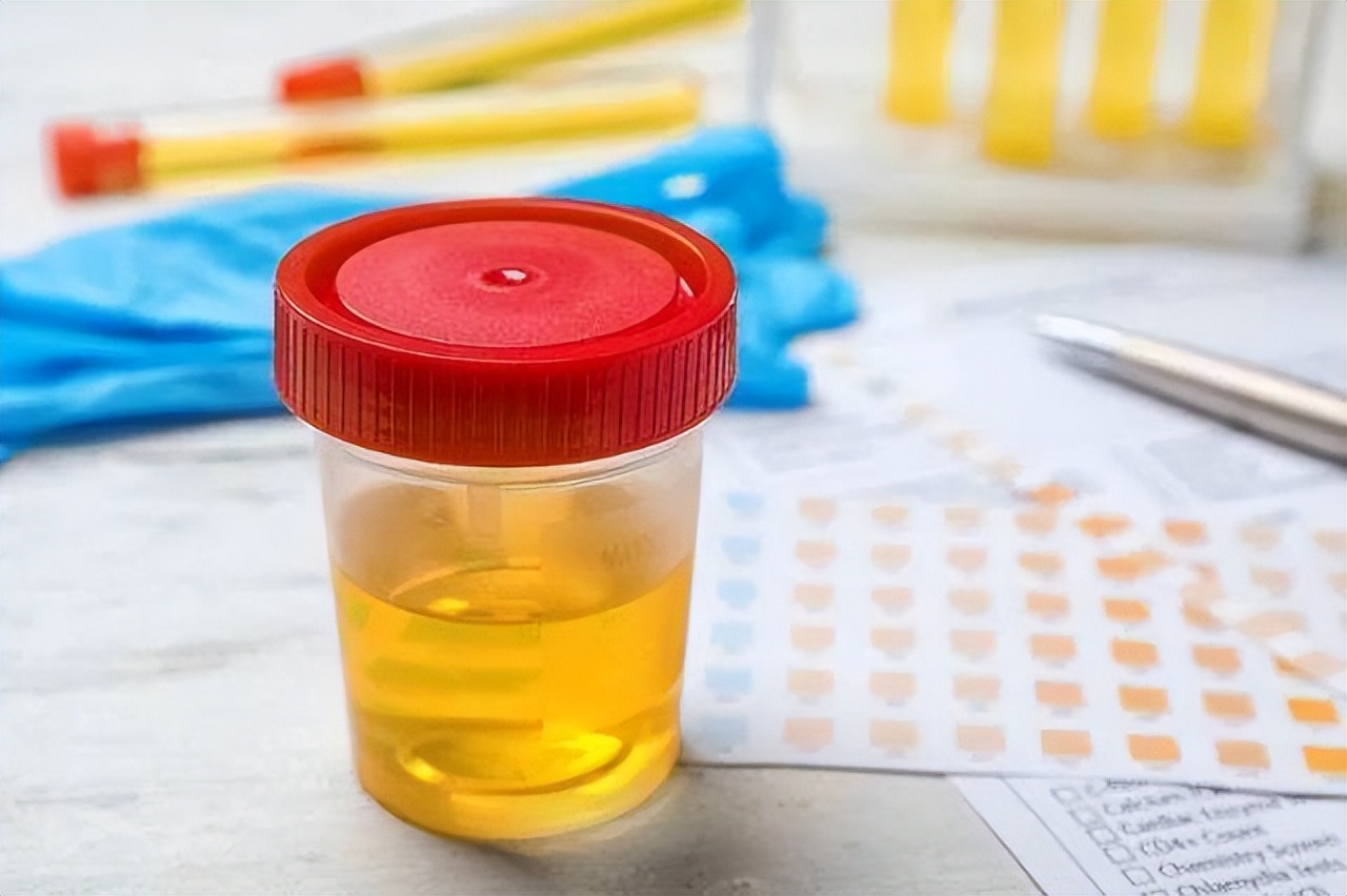 排尿气味大可能是4种病的警告,排尿很黄异味很大是什么病的信号