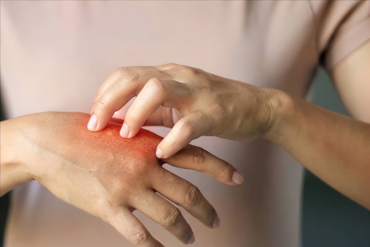 什么药膏专治皮肤过敏湿疹荨麻疹,止痒去荨麻疹的草药
