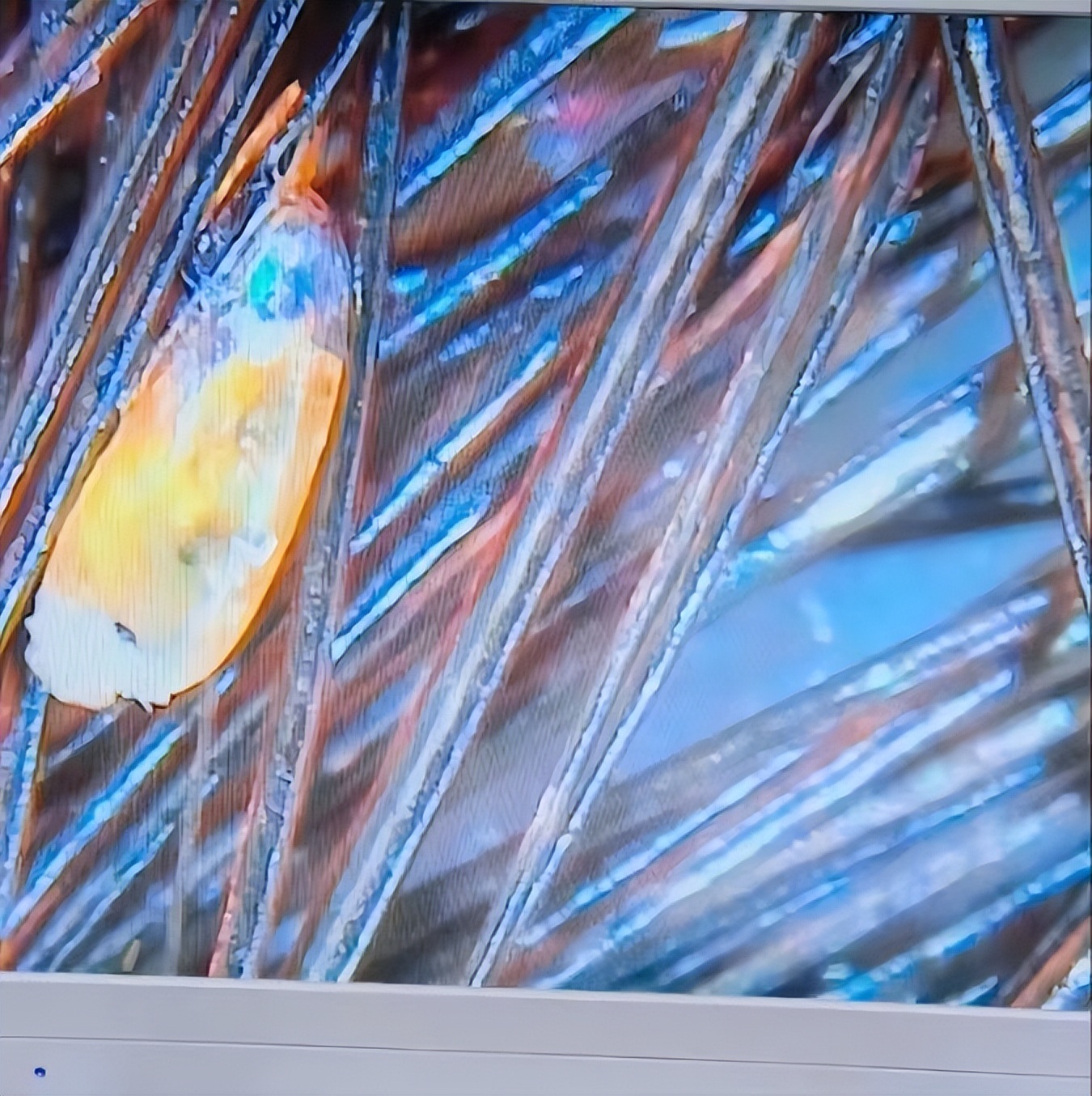 男子腹部痒，医生用镊子夹出12只阴虱！原来阴虱有这3个传播途径