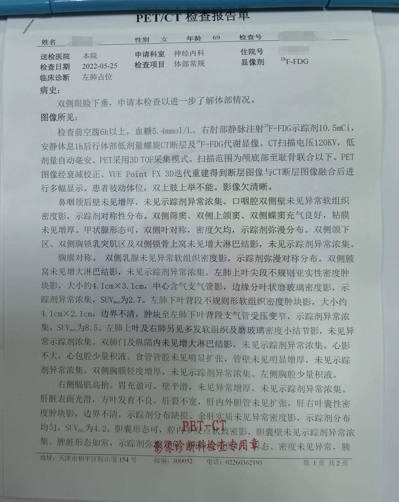 刘懿谈肺癌结节,刘懿博士说肺癌症