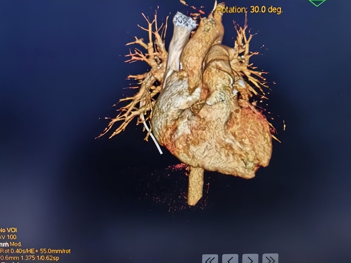 picc拔管遇导管断裂如何处理,picc导管断裂的影像表现