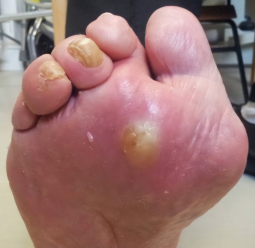 拇外翻疼痛怎么治疗最好,轻度拇外翻疼痛怎么办吃什么药