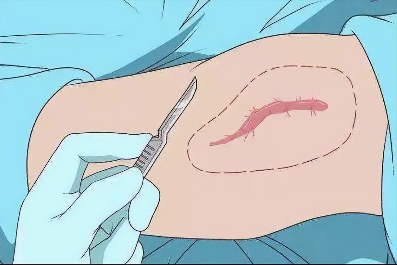 这种方式的腹腔镜手术，真正实现腹部“零瘢痕”