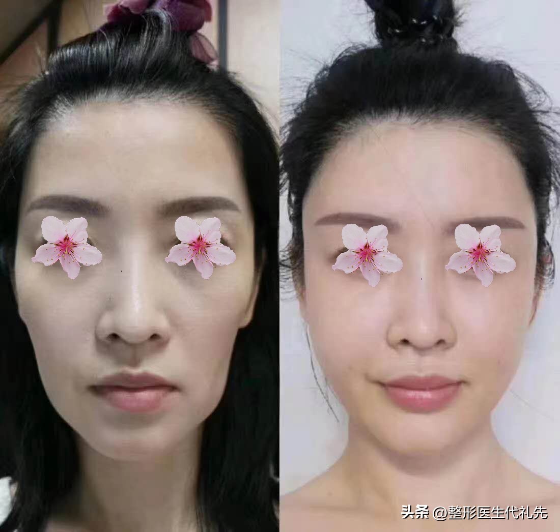 太阳穴凹陷怎么造成,太阳穴和脸颊突然凹陷的原因