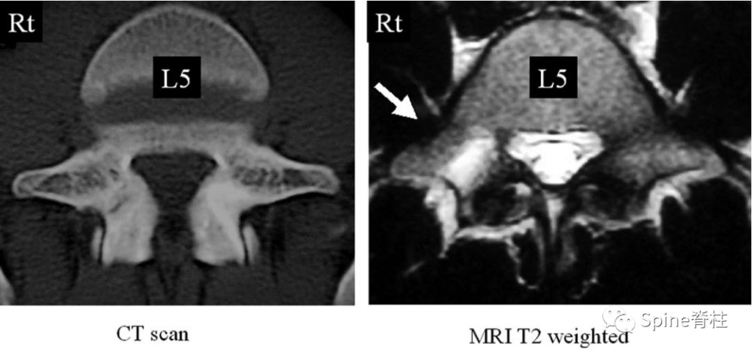 峡部裂和隐性峡部裂有区别吗,单纯峡部裂可以做峡部修复吗
