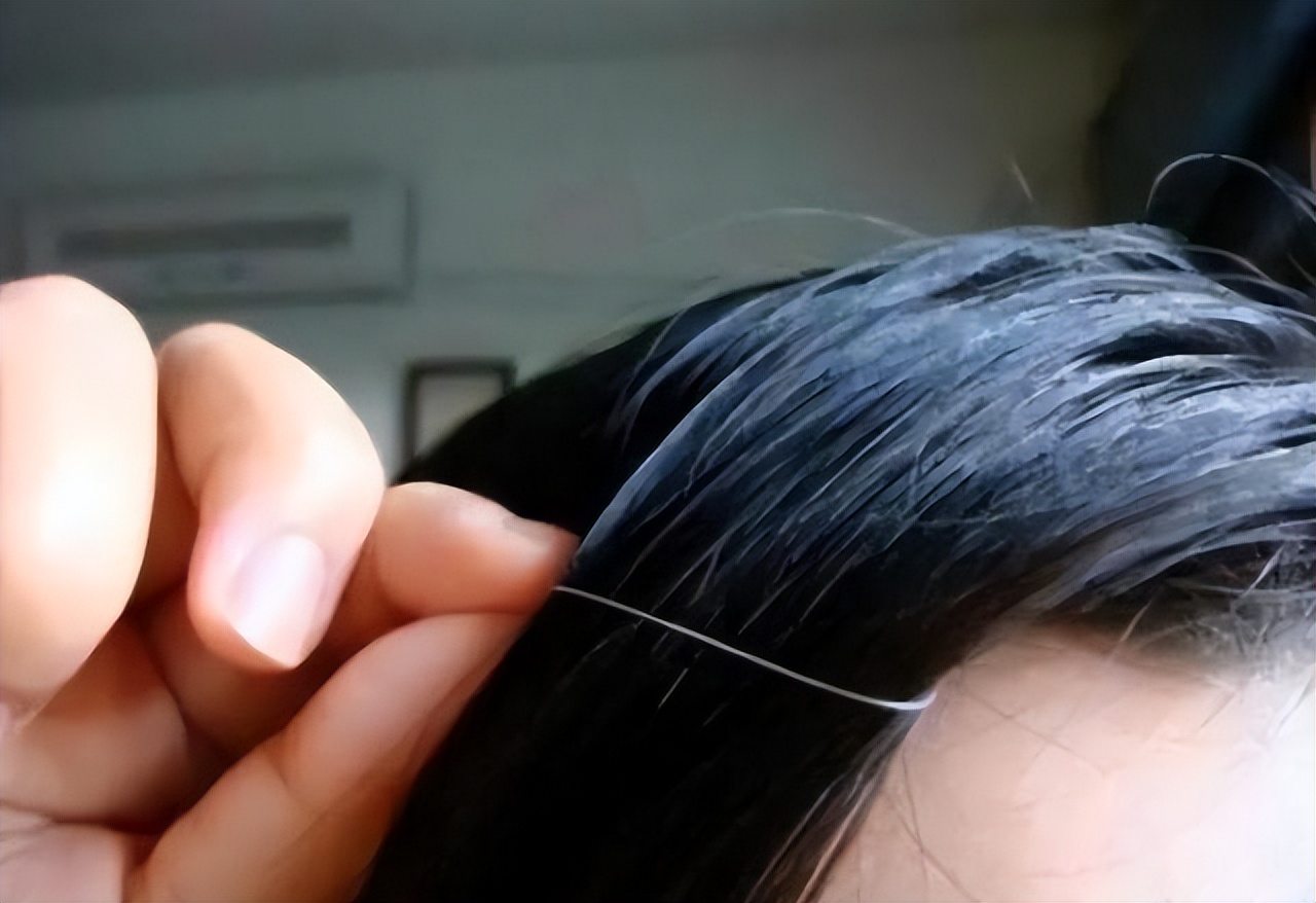 为什么越来越多的年轻人长白头发,年轻人长白发的原因及治疗方法