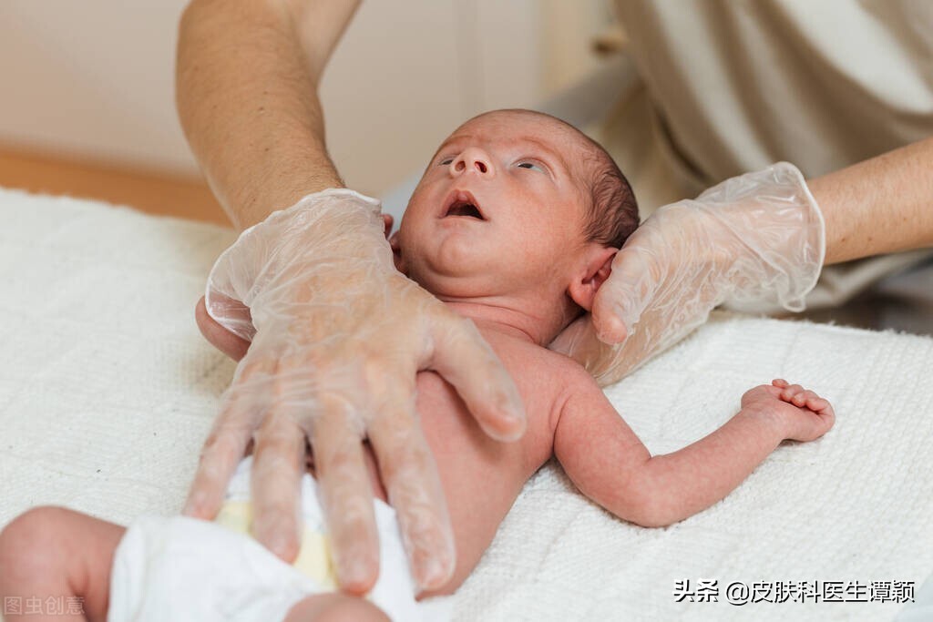 什么是尿布性皮炎,尿布性皮炎怎么治