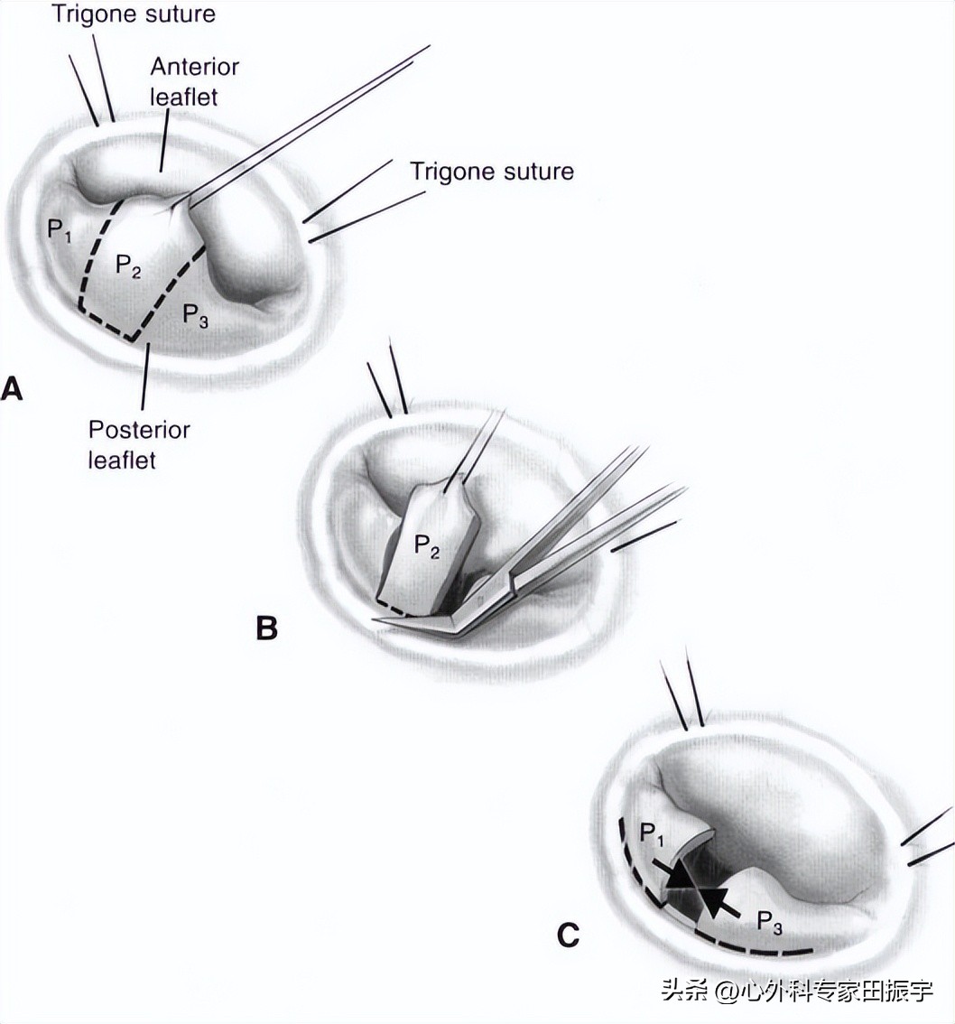 二尖瓣成形术要多少钱,二尖瓣成形术后抗凝多久
