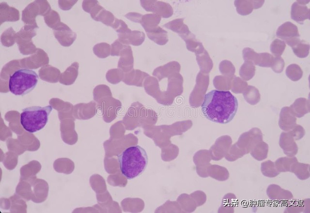 肿瘤患者白细胞升得过高可好,癌症患者白细胞40000高好吗