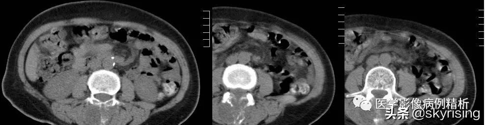 脊索瘤造成骨质破坏严重吗,多发椎体骨质破坏考虑转移瘤