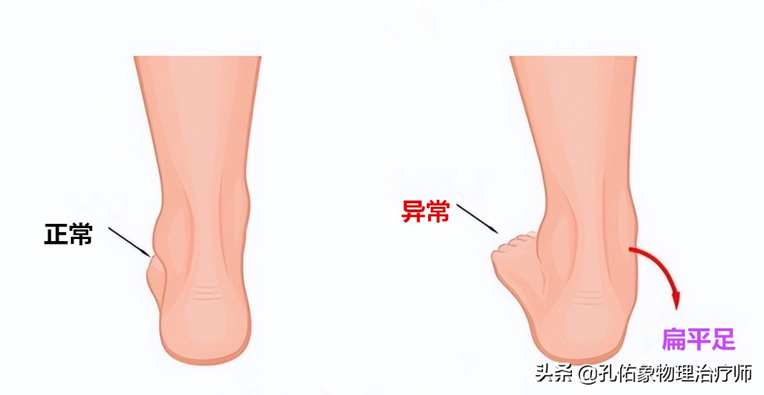 足跟疼痛一走路就疼,走路多足跟痛一招教你解决