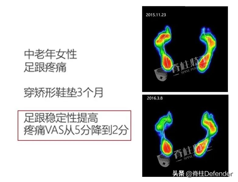 足跟痛筋膜炎最佳的治疗方法,足跟痛和足底筋膜炎康复治疗