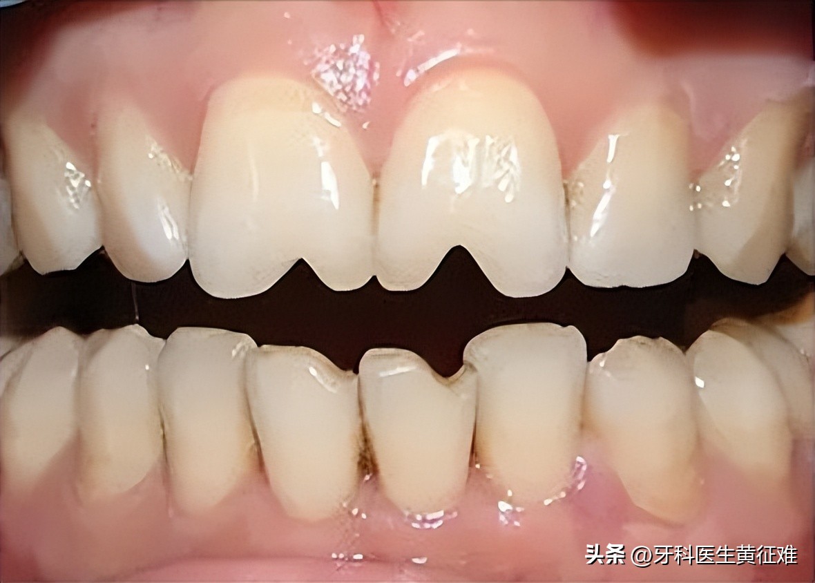 牙齿松动酸痛的原因是什么,牙齿咬起来酸痛是什么原因