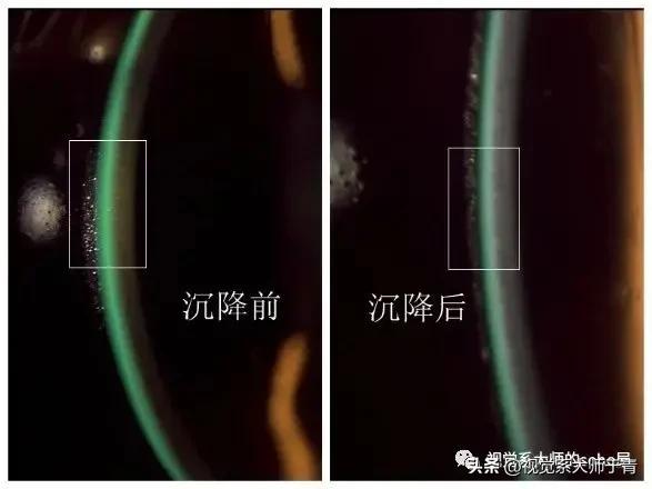 巩膜镜的验配技巧及案例分享,试戴巩膜镜成功率高不高