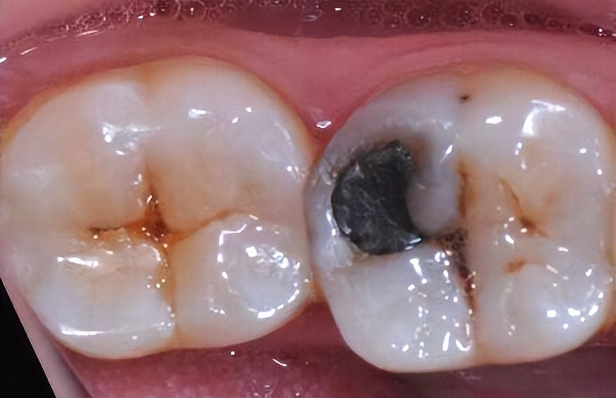 牙齿矫正期间如何让牙齿不变黄,牙齿做完矫正之后变黄了怎么办