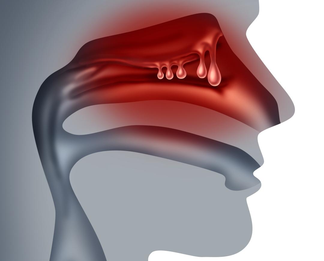 息肉到结肠癌需要多久,息肉到胃癌要多久