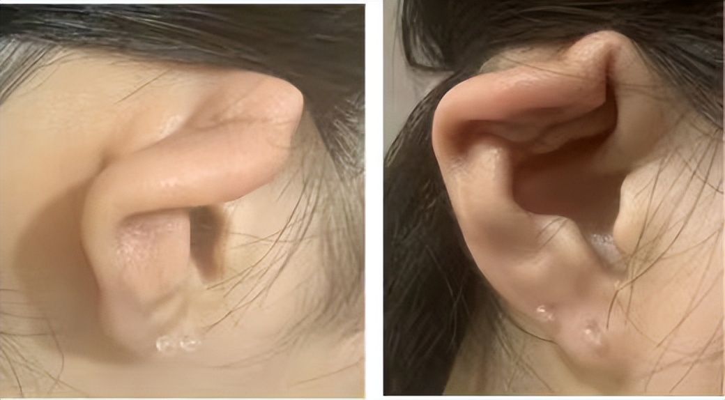 打耳洞感染需要取下耳钉吗,打耳洞感染几率大吗