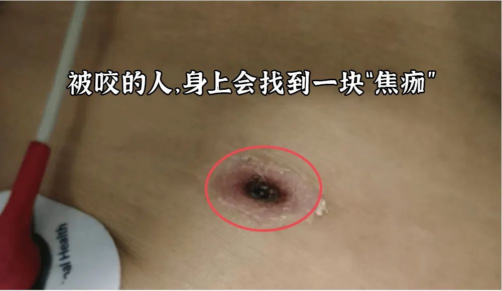 恙虫到底有多可怕？致死率极高