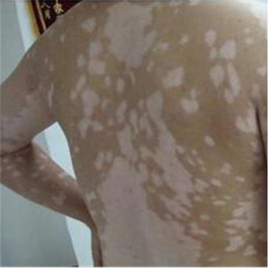 白斑扩散得很快怎么办,白斑扩散的最好治疗方法