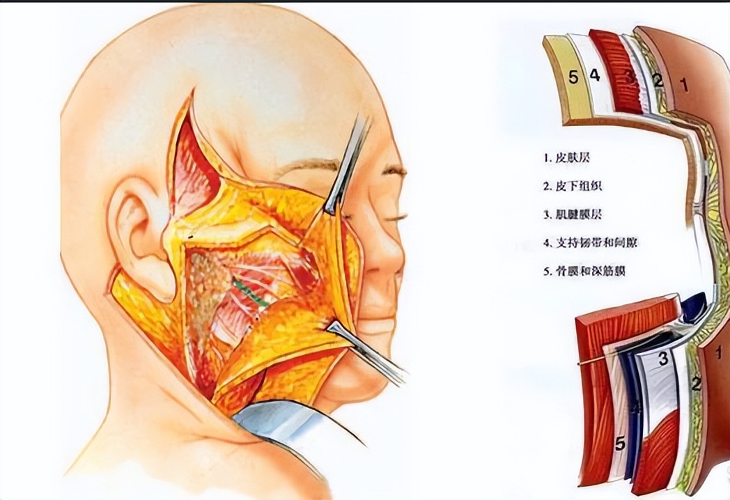全脸拉皮手术前后6天的效果,拉皮手术多长时间能全部消肿