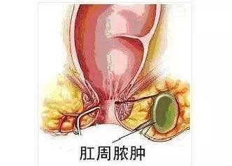肛门旁边长个痘怎么治疗,肛门附近长痘怎么治疗