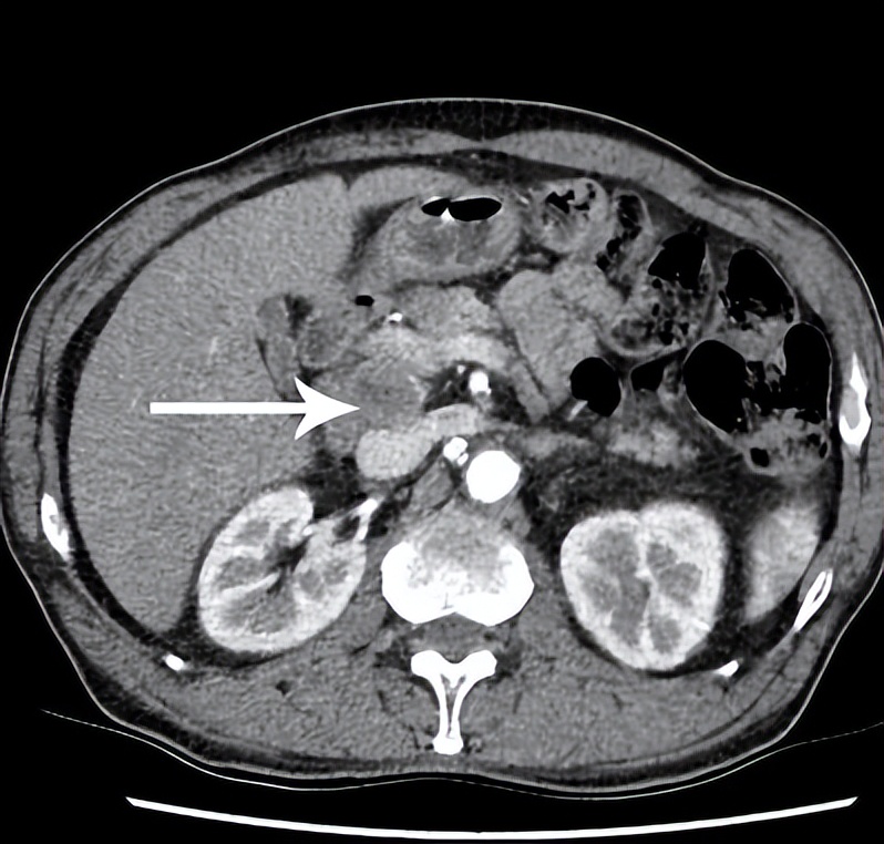粒子植入适合腹膜后淋巴结吗,腹膜后淋巴结转移化疗效果